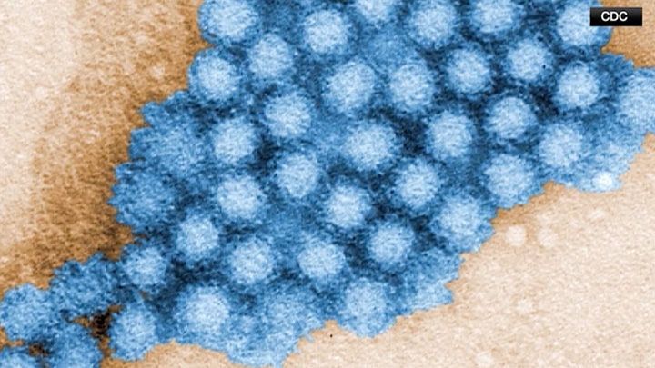 Norovirus cases on the rise: Medical expert shares advice on how to prevent contracting the virus